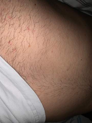 Ist Das Syphilis Gesundheit Und Medizin Sex Geschlechtskrankheiten Ist Das Syphilis Gesundheit Und Medizin Sex Geschlechtskrankheiten