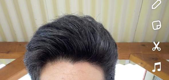Ist das vorne Haarausfall oder normal?