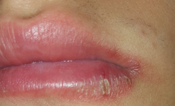 Ist Das Was Ich An Meiner Lippe Habe Wirklich Herpes