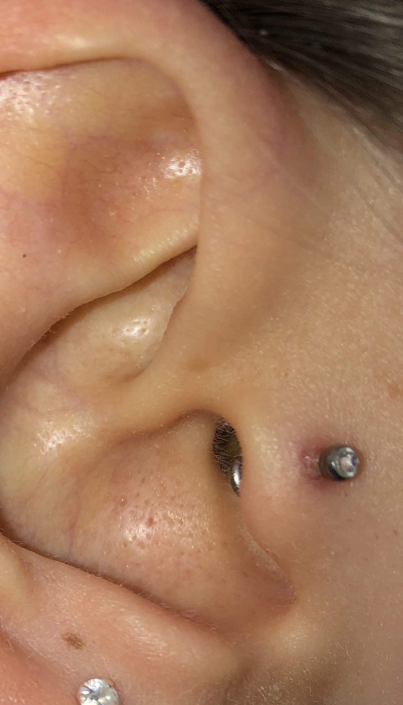 Gel piercing wildfleisch tyrosur Wundfleisch