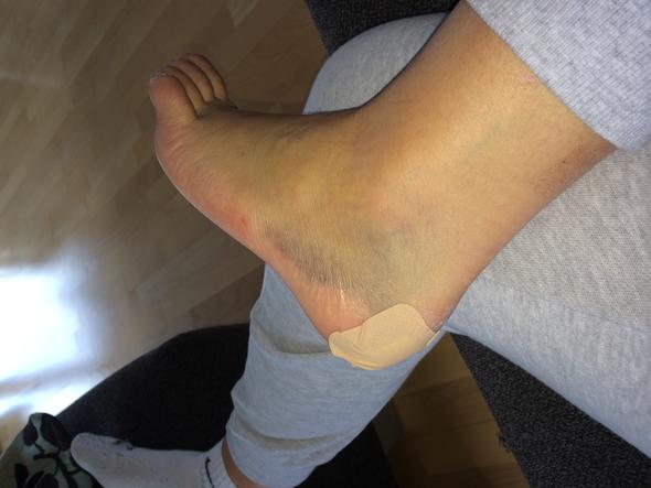 Ist das wirklich ein Bänderriss? (Sprunggelenk) stützstrumpf bänderriss