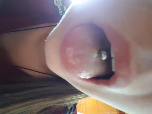 Ist Das Wundsekret Oder Ist Das Eiter Gesundheit Und Medizin Zungenpiercing Ist Das Wundsekret Oder Ist Das Eiter Gesundheit Und Medizin Zungenpiercing