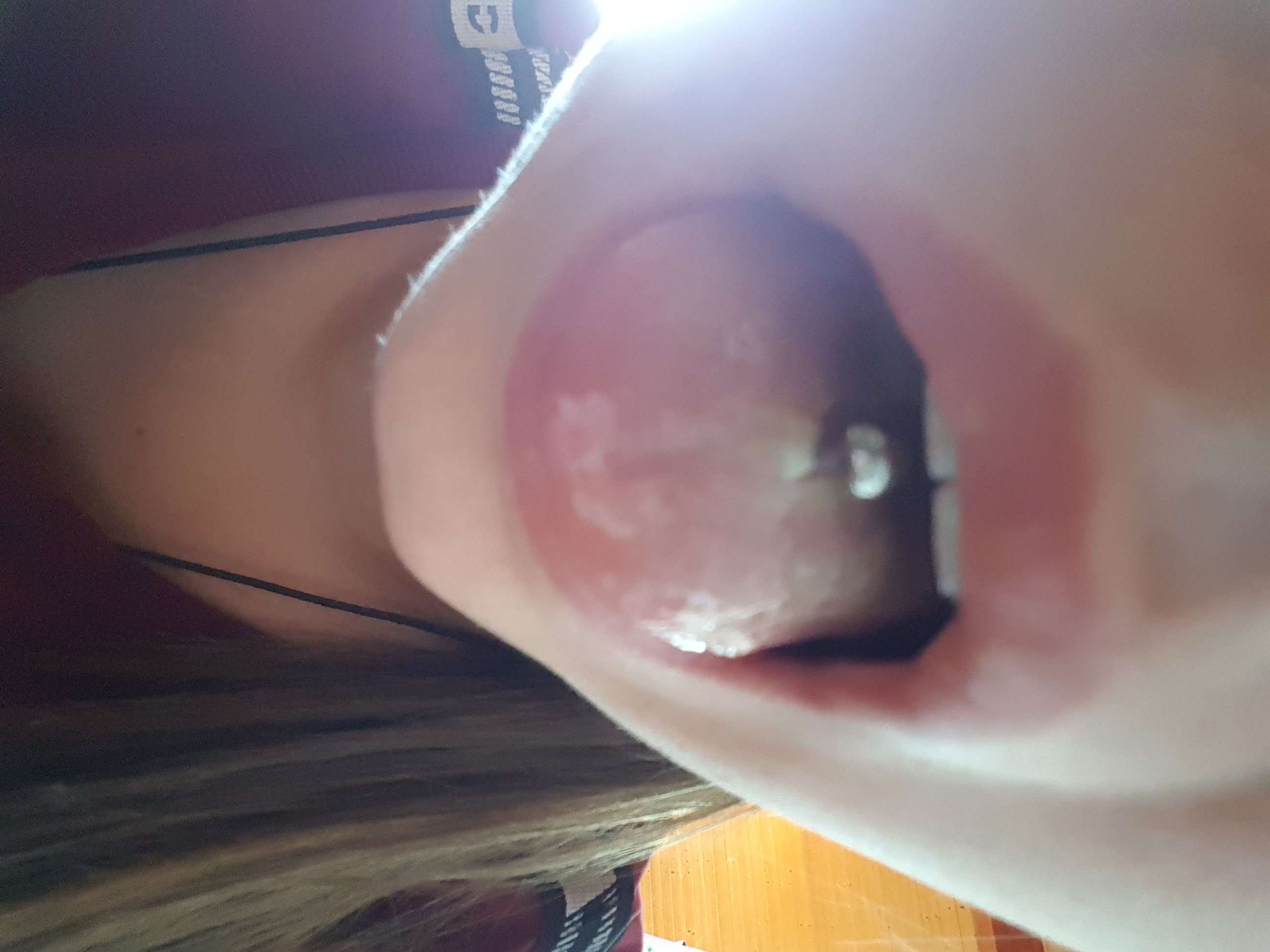 Ist Das Wundsekret Oder Ist Das Eiter Gesundheit Und Medizin Zungenpiercing Ist Das Wundsekret Oder Ist Das Eiter Gesundheit Und Medizin Zungenpiercing