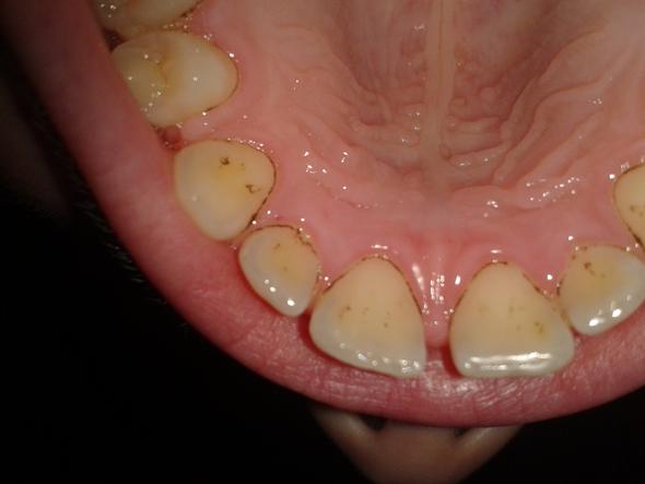 Unterkiefer - (Zähne, Zahnarzt, Zahnmedizin)