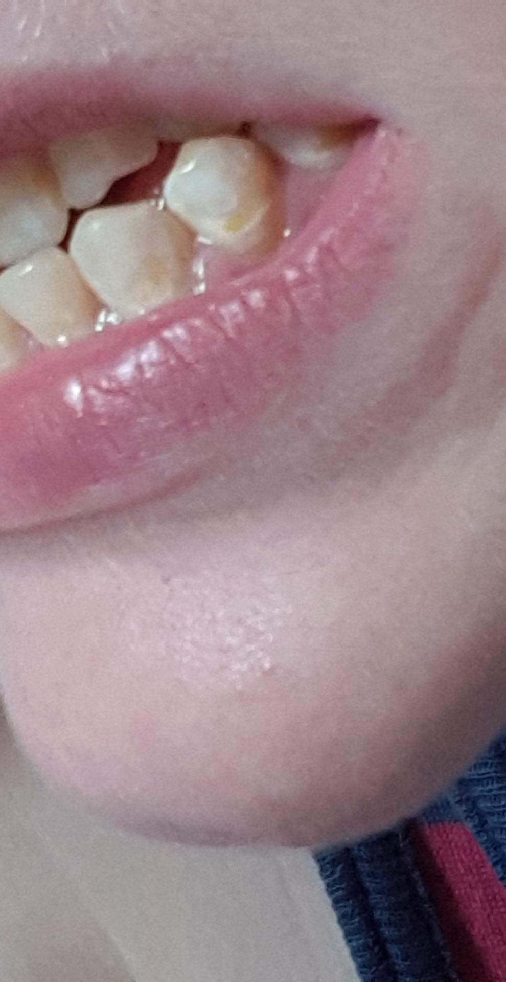 Ist das Zahnstein? (Gesundheit und Medizin, Zähne)