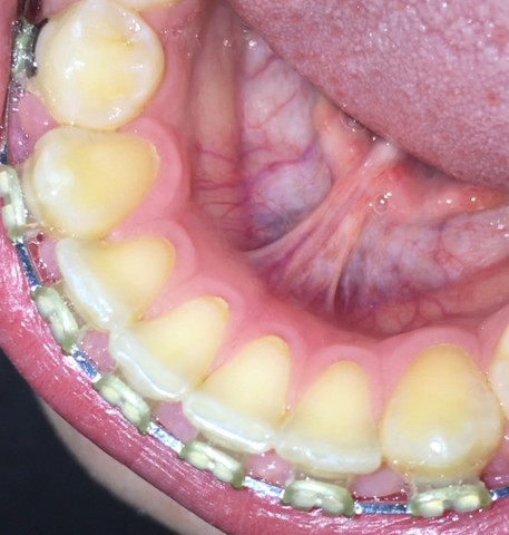 Das Bild - (Zähne, Zahnarzt, Zahnstein)