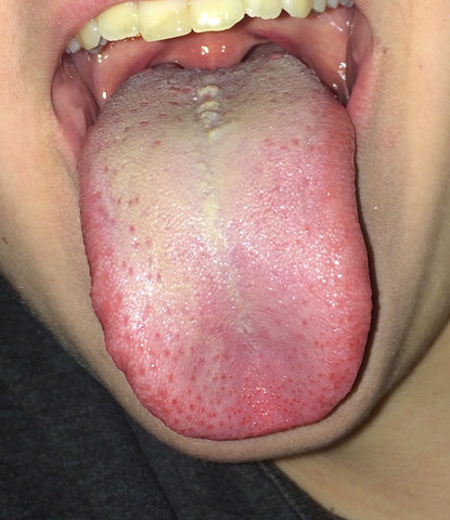 Ist Das Zugenkrebs Oder Was Krankheit Weisse Flecken Mundraum Ist Das Zugenkrebs Oder Was Krankheit Weisse Flecken Mundraum