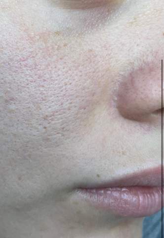 Ist Das Couperose Haut Dermatologie Adern Ist Das Couperose Haut Dermatologie Adern