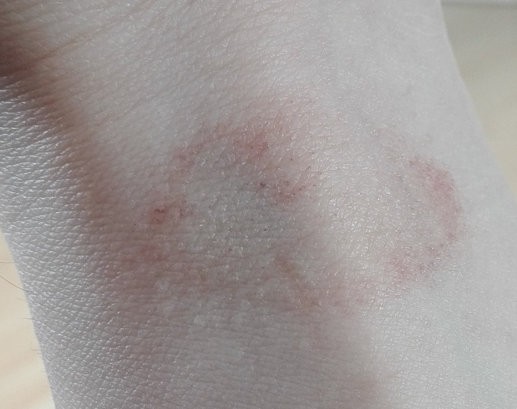 Ist der Ausschlag an meinem Unterarm ein Primärmedaillon einer ...