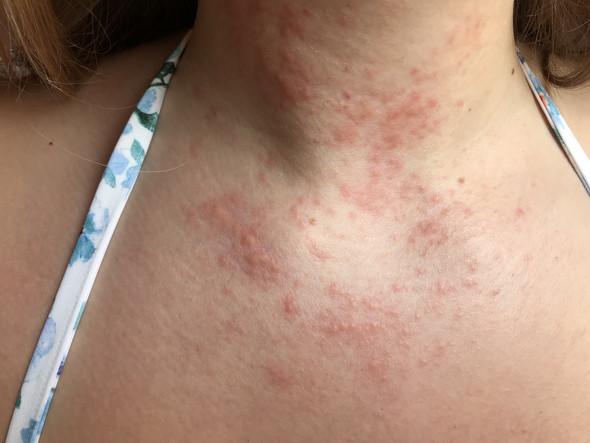 Ist Der Ausschlag Schlimm Oder Geht Er Nach Paar Tagen Wieder Weg Gesundheit Und Medizin Gesundheit Medizin Ist Der Ausschlag Schlimm Oder Geht Er Nach Paar Tagen Wieder Weg Gesundheit Und Medizin Gesundheit Medizin