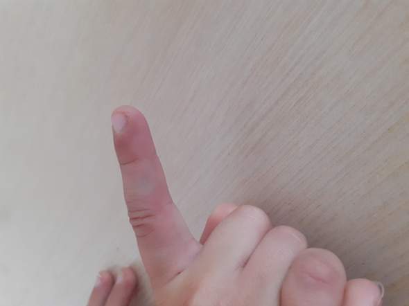 Ist Der Fimger Gebrochen Oder Nicht Gesundheit Und Medizin Finger Ist Der Fimger Gebrochen Oder Nicht Gesundheit Und Medizin Finger