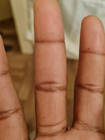 Kapselriss im finger