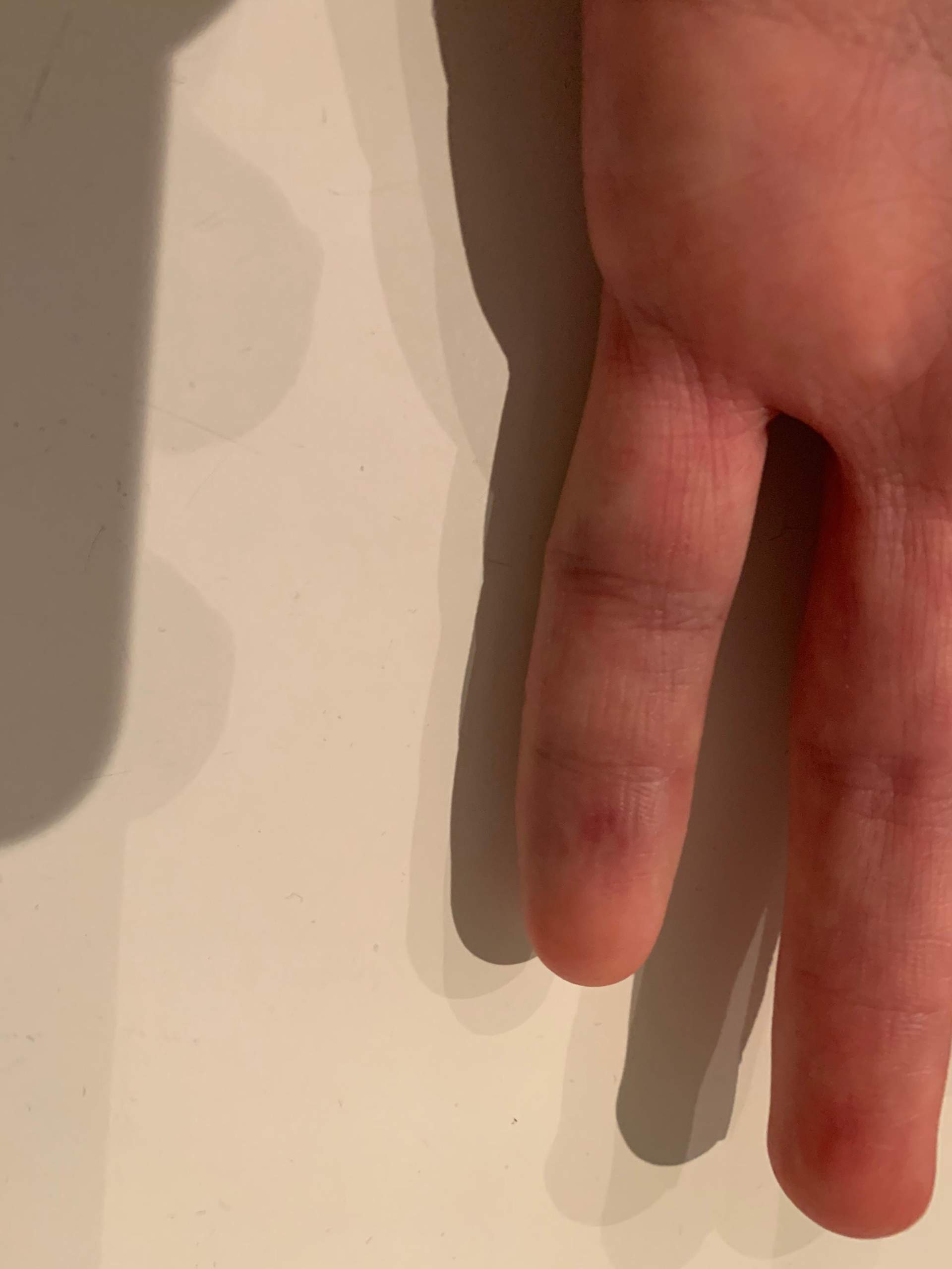 Lange wie geschwollen verstaucht finger Handgelenksverletzungen