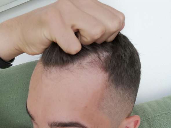 Ist Der Haarausfall Stark Fur Mein Alter Gesundheit Und Medizin Gesundheit Haare