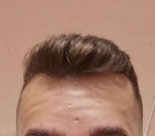 haarausfall stark fur mein alter