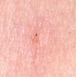 Ist Der Kopf Von Der Zecke Noch Drin Gesundheit Und Medizin Hals Ist Der Kopf Von Der Zecke Noch Drin Gesundheit Und Medizin Hals