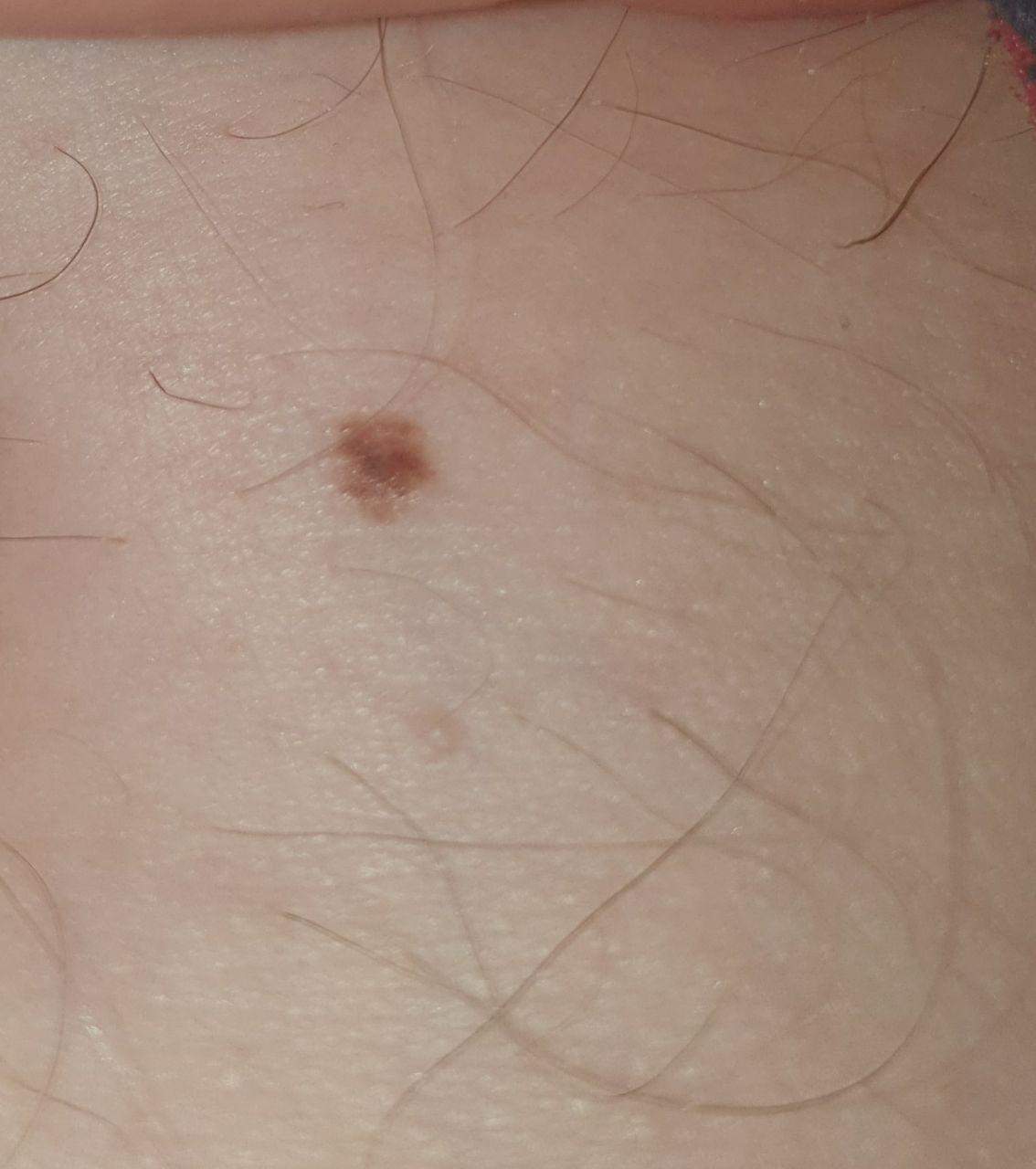 Ist der Leberfleck auffällig? (Hautkrebs)