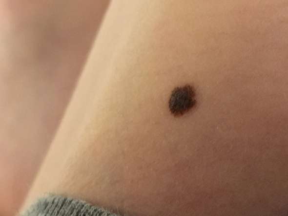ist Der Leberfleck normal oder nicht bzw. gefährlich? (Muttermal)