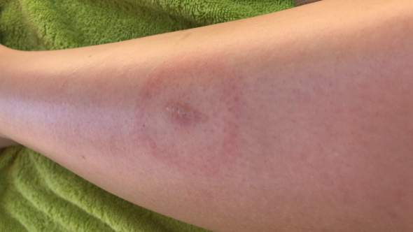 Brise Zentralisieren Anreicherung roter ring um mückenstich Tutor Ich brauche segeln