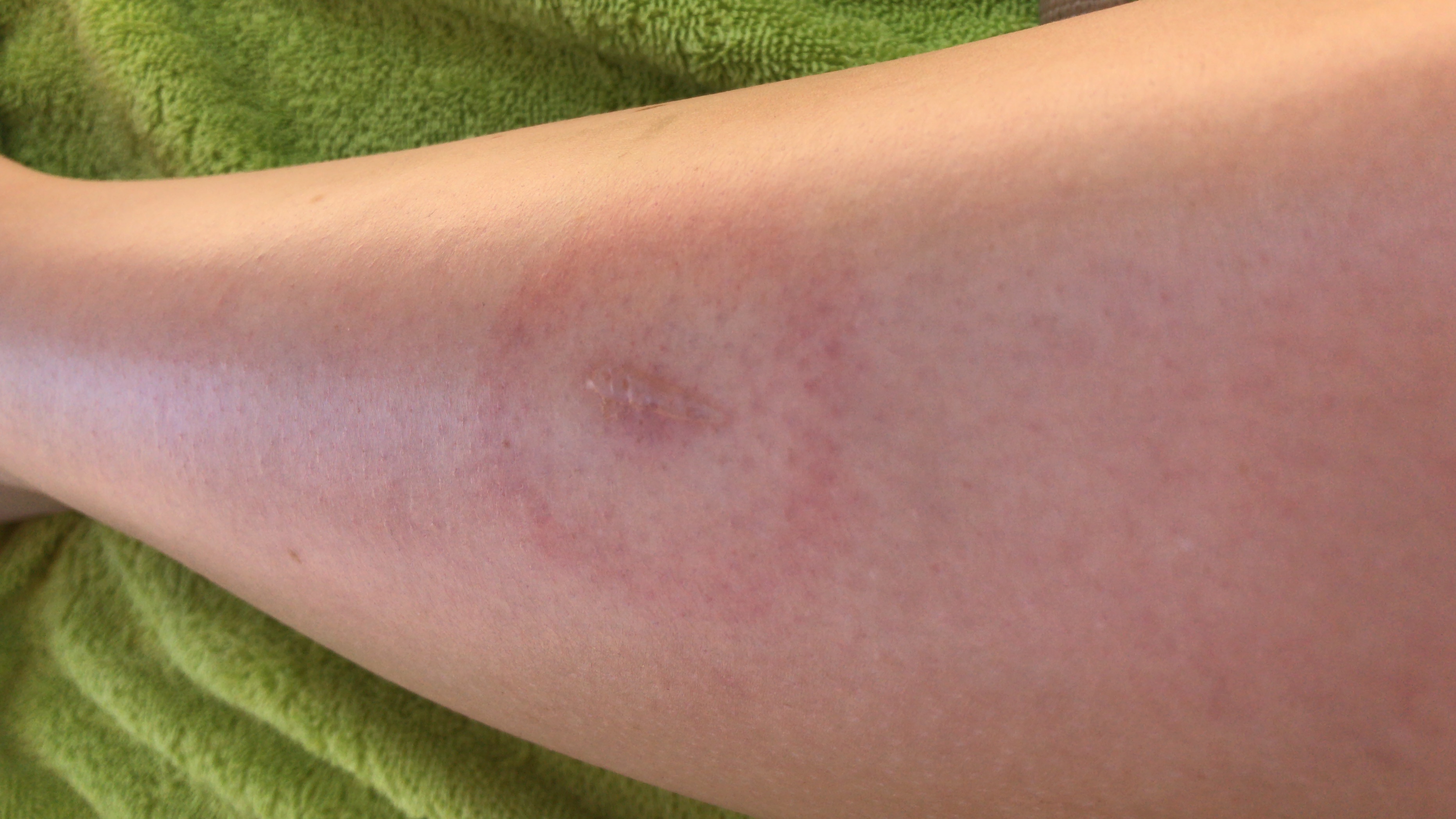 Ist der Mückenstich entzündet? (Mückenstiche)