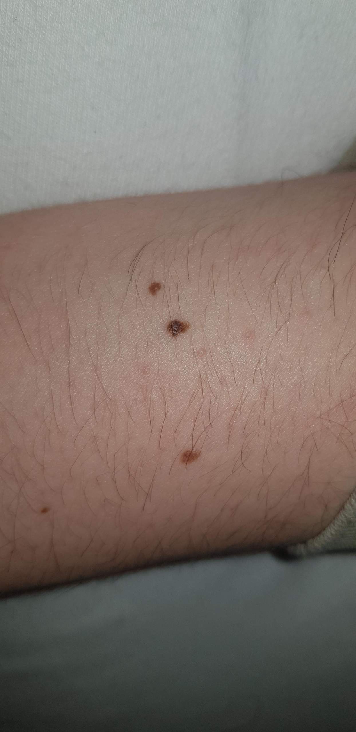 Ist der muttermal in der Mitte auffälig also muss ich zum Arzt