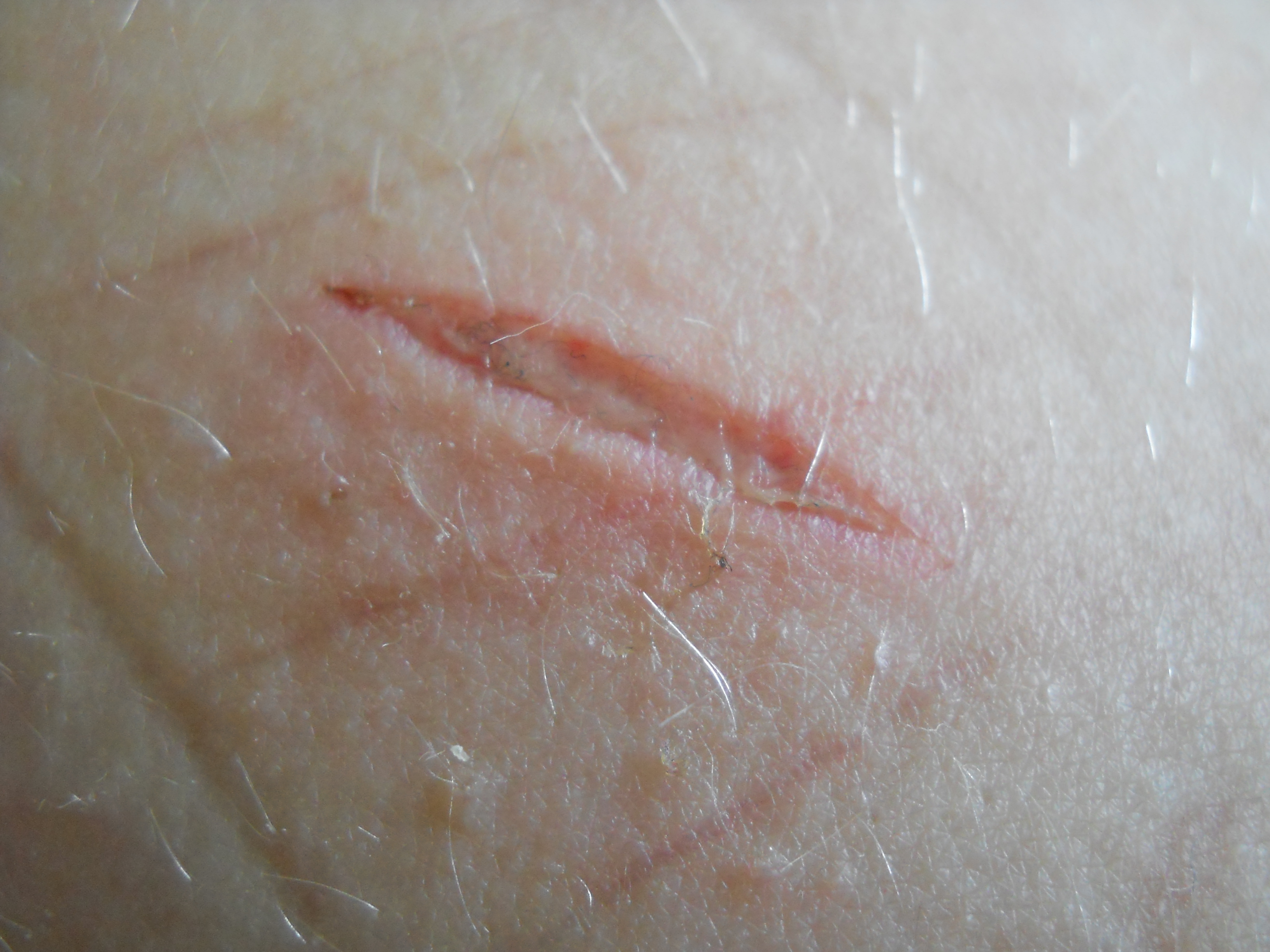 Ist der Schnitt entzündet? (Wunde)