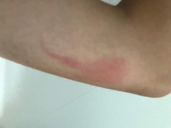 Ist Der Stich Schlimm Blutvergiftung Etc Gesundheit Und Medizin Gesundheit Arzt Ist Der Stich Schlimm Blutvergiftung Etc Gesundheit Und Medizin Gesundheit Arzt