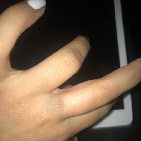 Ist Die Ader Geplatzt Gesundheit Und Medizin Gesundheit Sport Ist Die Ader Geplatzt Gesundheit Und Medizin Gesundheit Sport