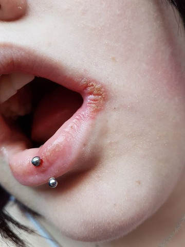 Ist Die Gelbe Kruste Am Mundwinkel Herpes Medizin Mund Ist Die Gelbe Kruste Am Mundwinkel Herpes Medizin Mund