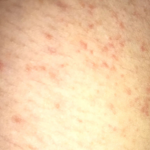 Ist Die Kratze Immernoch Da Gesundheit Und Medizin Haut Pickel Ist Die Kratze Immernoch Da Gesundheit Und Medizin Haut Pickel