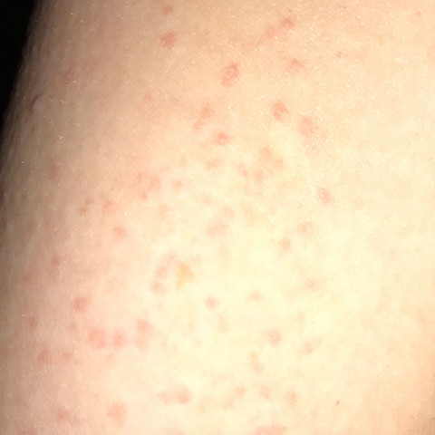 Ist Die Kratze Immernoch Da Gesundheit Und Medizin Haut Pickel Ist Die Kratze Immernoch Da Gesundheit Und Medizin Haut Pickel