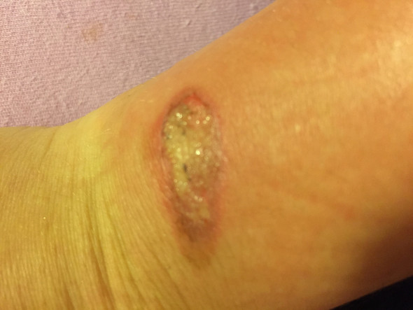 Bild 1 - (Medizin, Narben, Wunde)