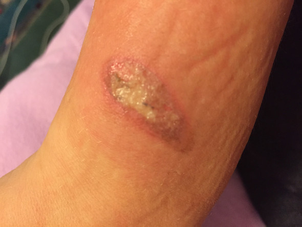 Bild 2 - (Medizin, Narben, Wunde)