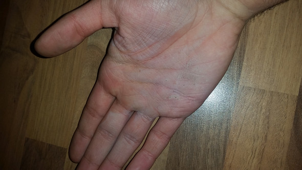 Verbrennung der Handfläche - (Arzt, Hand, Feuer)