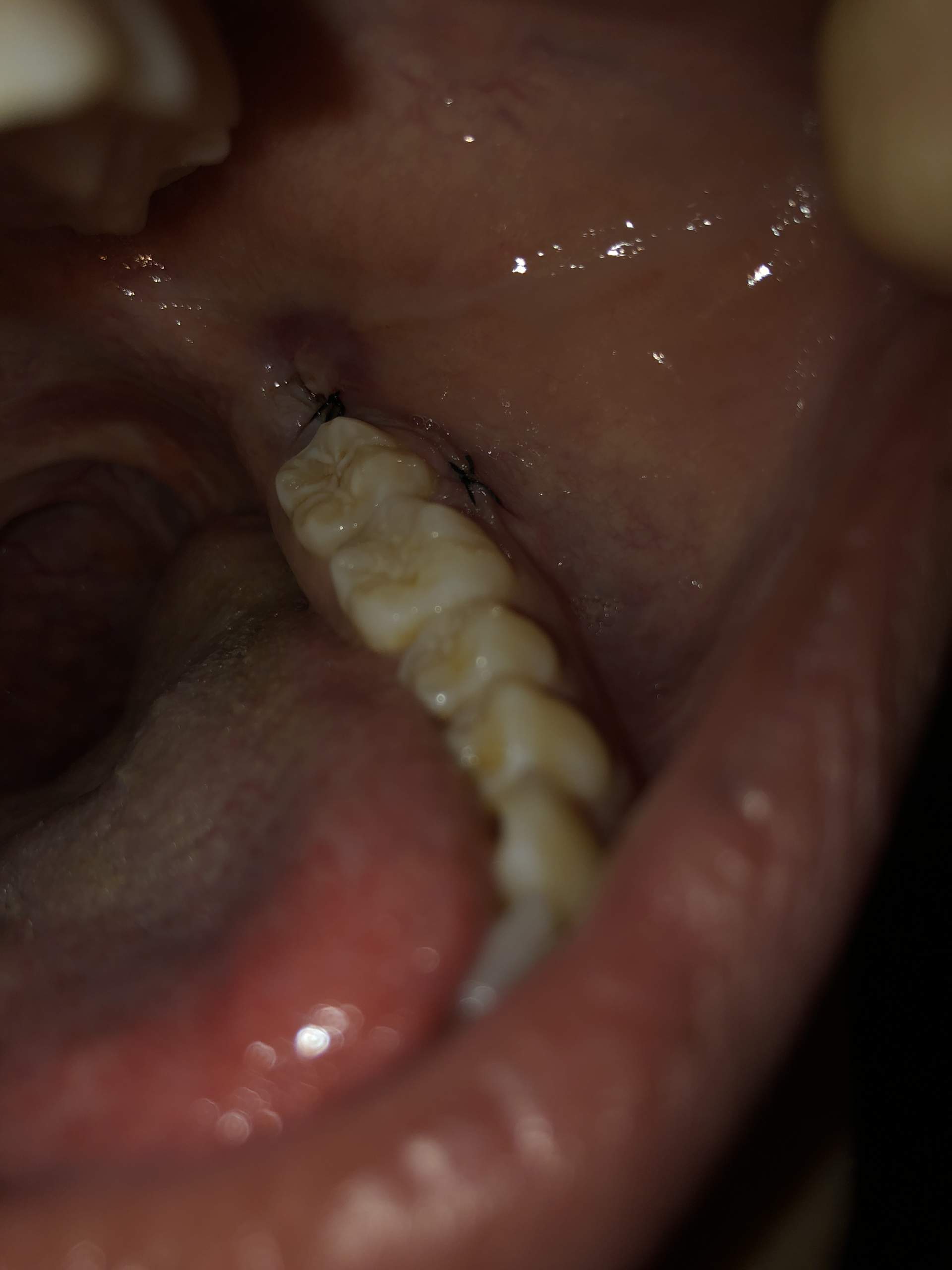 Ist die Wunde nach der Weisheitszahn OP entzündet? (Gesundheit und Medizin, Entzündung ...