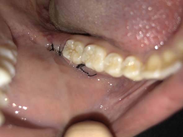 Ist die Wunde nach der Weisheitszahn OP entzündet? (Gesundheit und Medizin, Entzündung ...