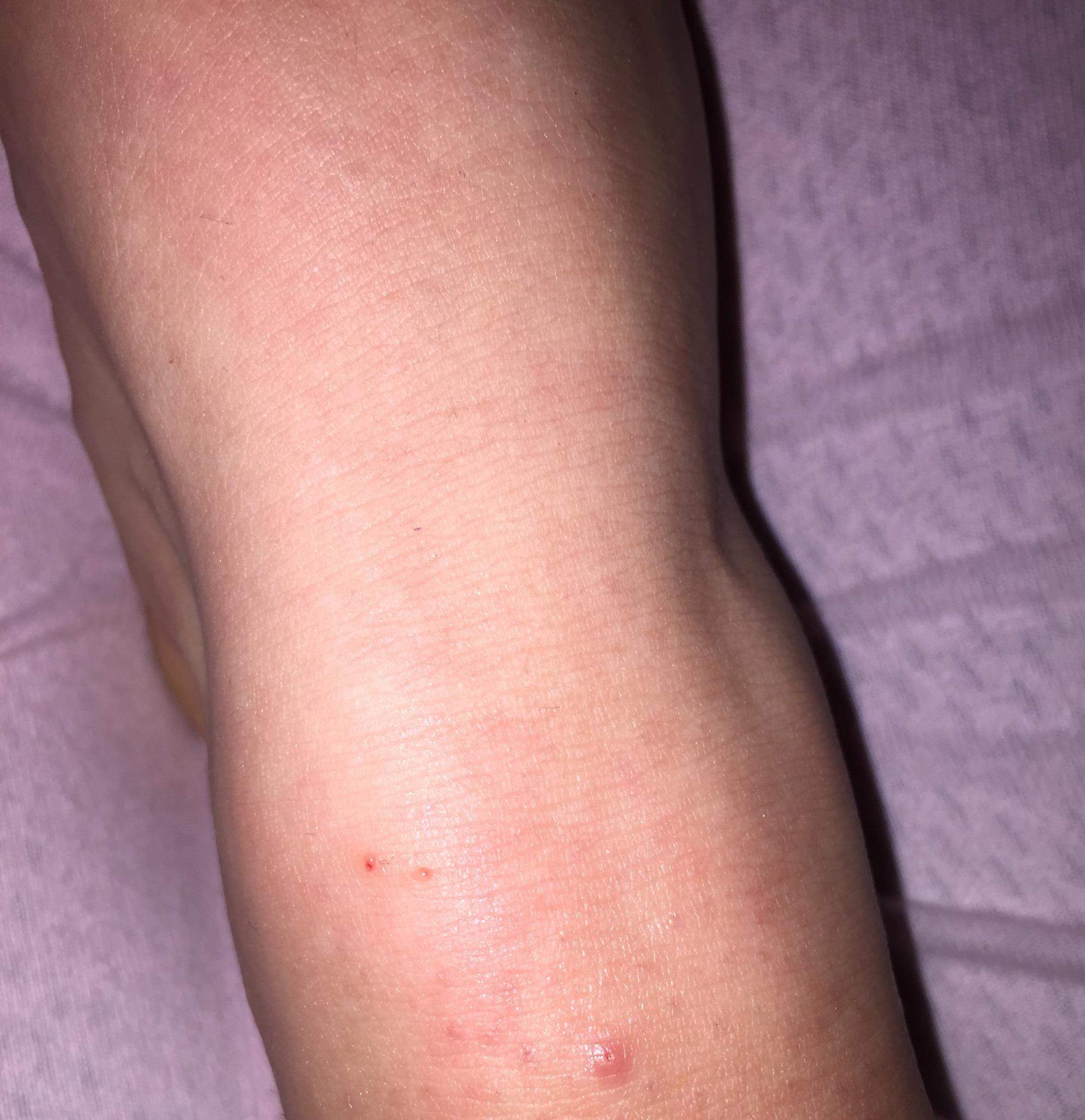 Ist Dies Ein Schlangenbiss Gesundheit Und Medizin Gesundheit Tiere Ist Dies Ein Schlangenbiss Gesundheit Und Medizin Gesundheit Tiere