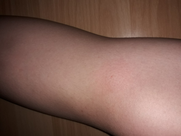 - (Angst, Natur, Biss)