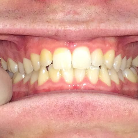 Das sind meine Zähne direkt nach dem abendlichem Zähneputzen - (Gesundheit, Zähne, Zahnarzt)