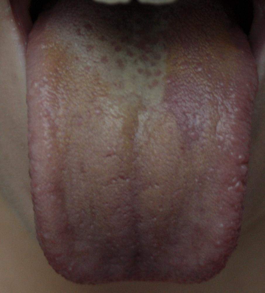 Ist diese Zunge normal? (Gesundheit, Flecken, gelb)