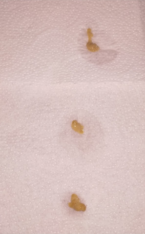 Ist Dieser Auswurf Normal Gesundheit Und Medizin Medizin Krank Ist Dieser Auswurf Normal Gesundheit Und Medizin Medizin Krank