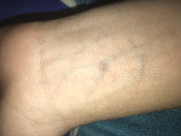 Ist Dieser Blaue Fleck Schlimm Blut Flecken Adern Ist Dieser Blaue Fleck Schlimm Blut Flecken Adern