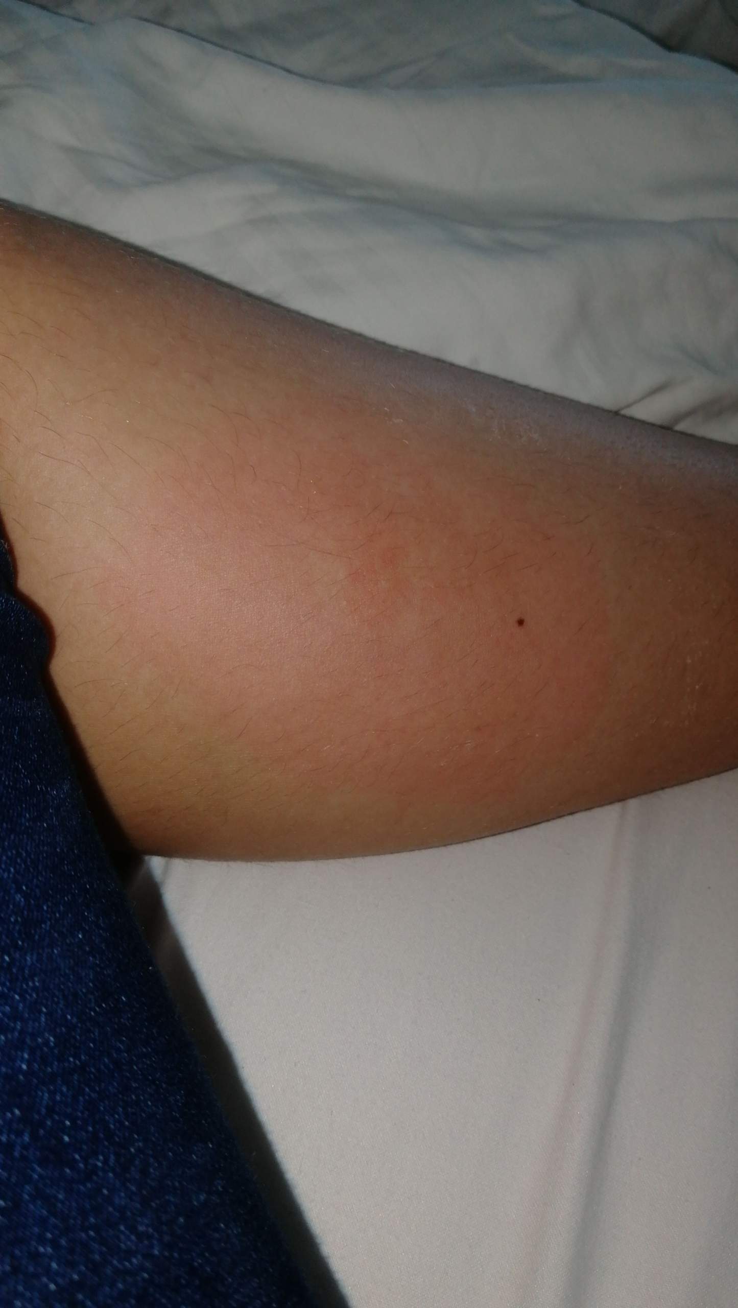Ist Dieser Bremsenstich Schlimm Allergische Reaktion Ist Dieser Bremsenstich Schlimm Allergische Reaktion