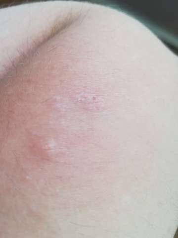 Ist dieser Fleck harmlos oder kann der gefährlich werden? (gesund)