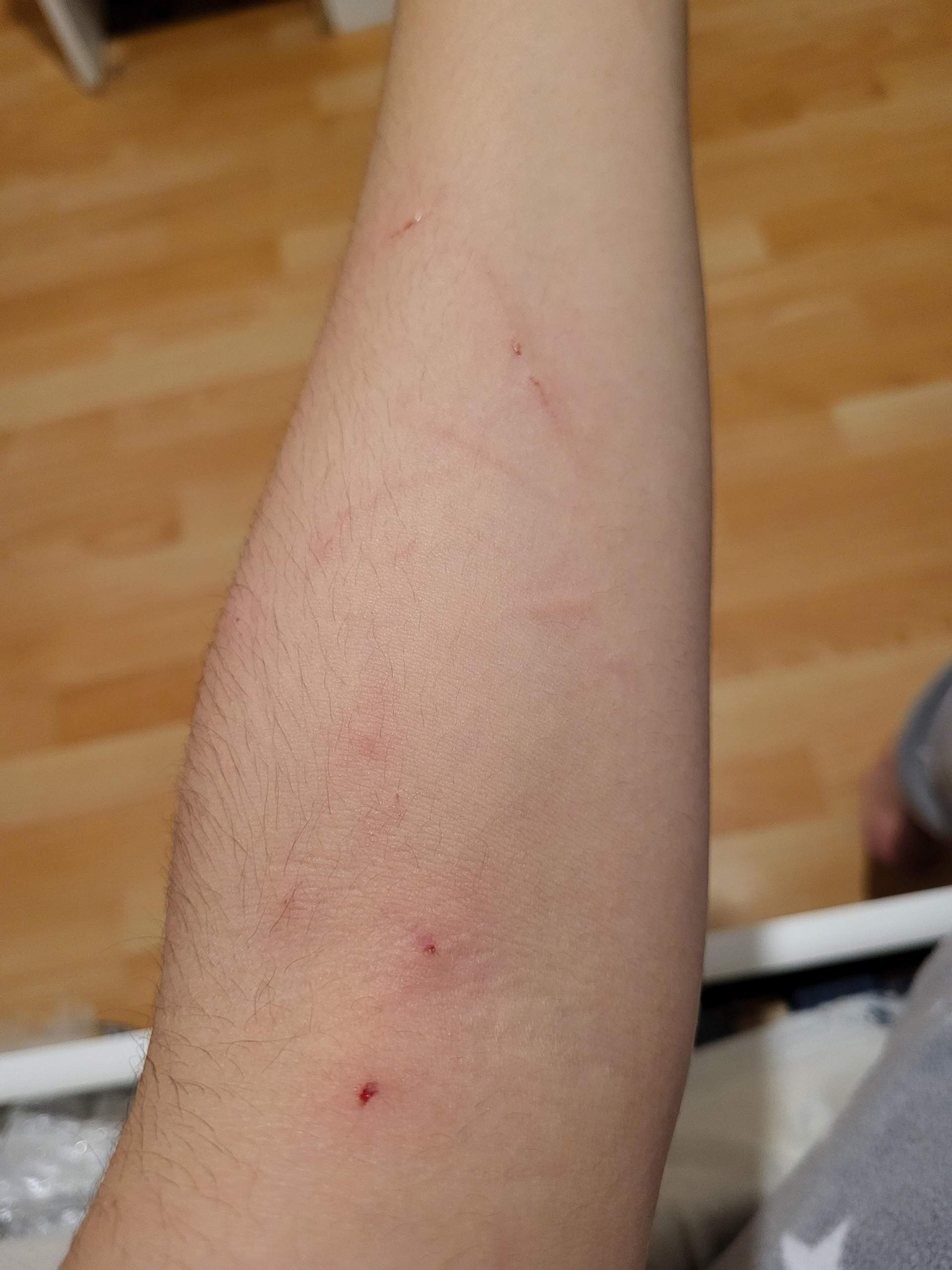 Ist dieser Katzenbiss gefährlich? (Gesundheit und Medizin, Katze, Biss)