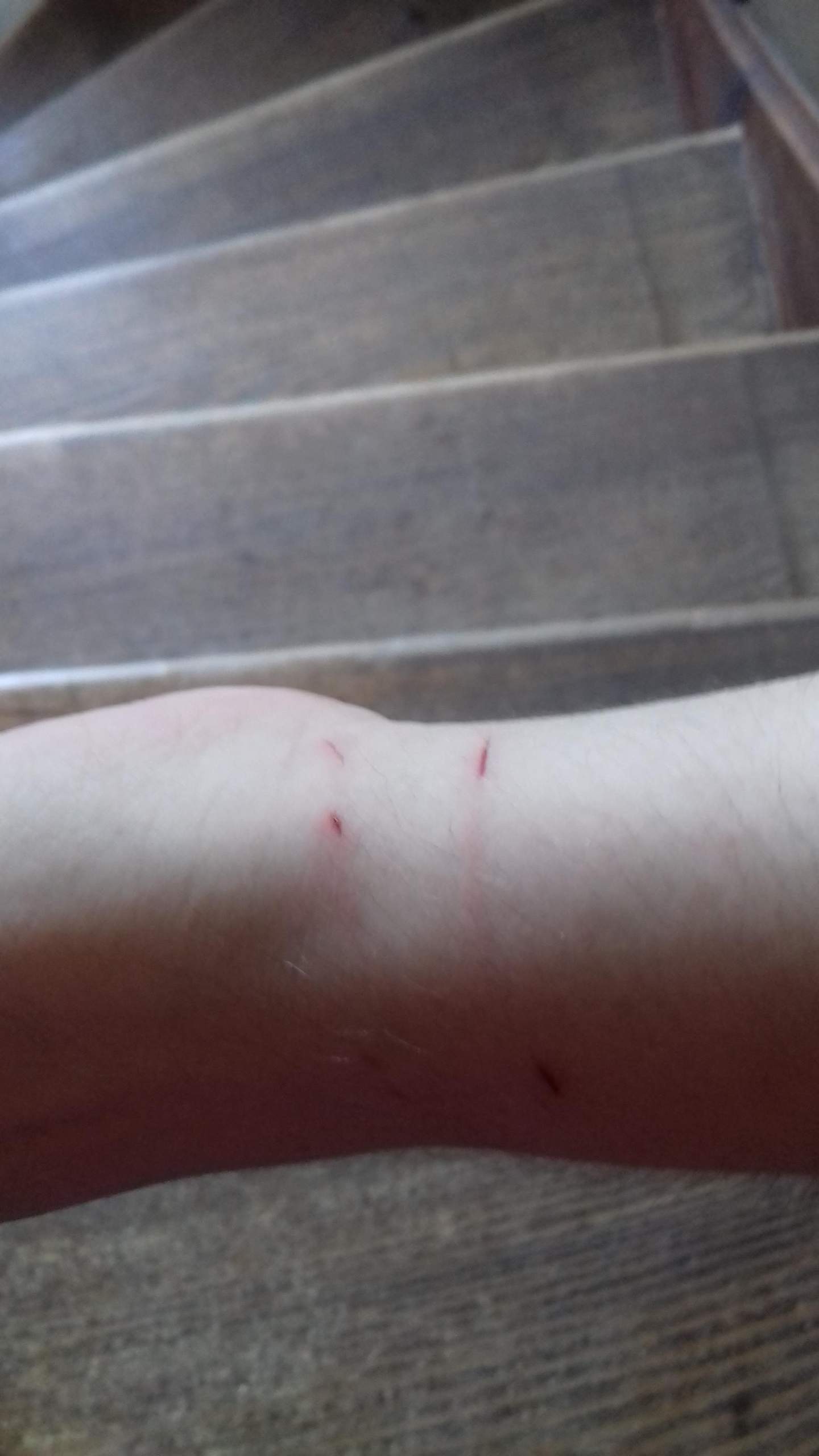 Ist dieser Katzenbiss schlimm? (Arzt, Katze, Verletzung)