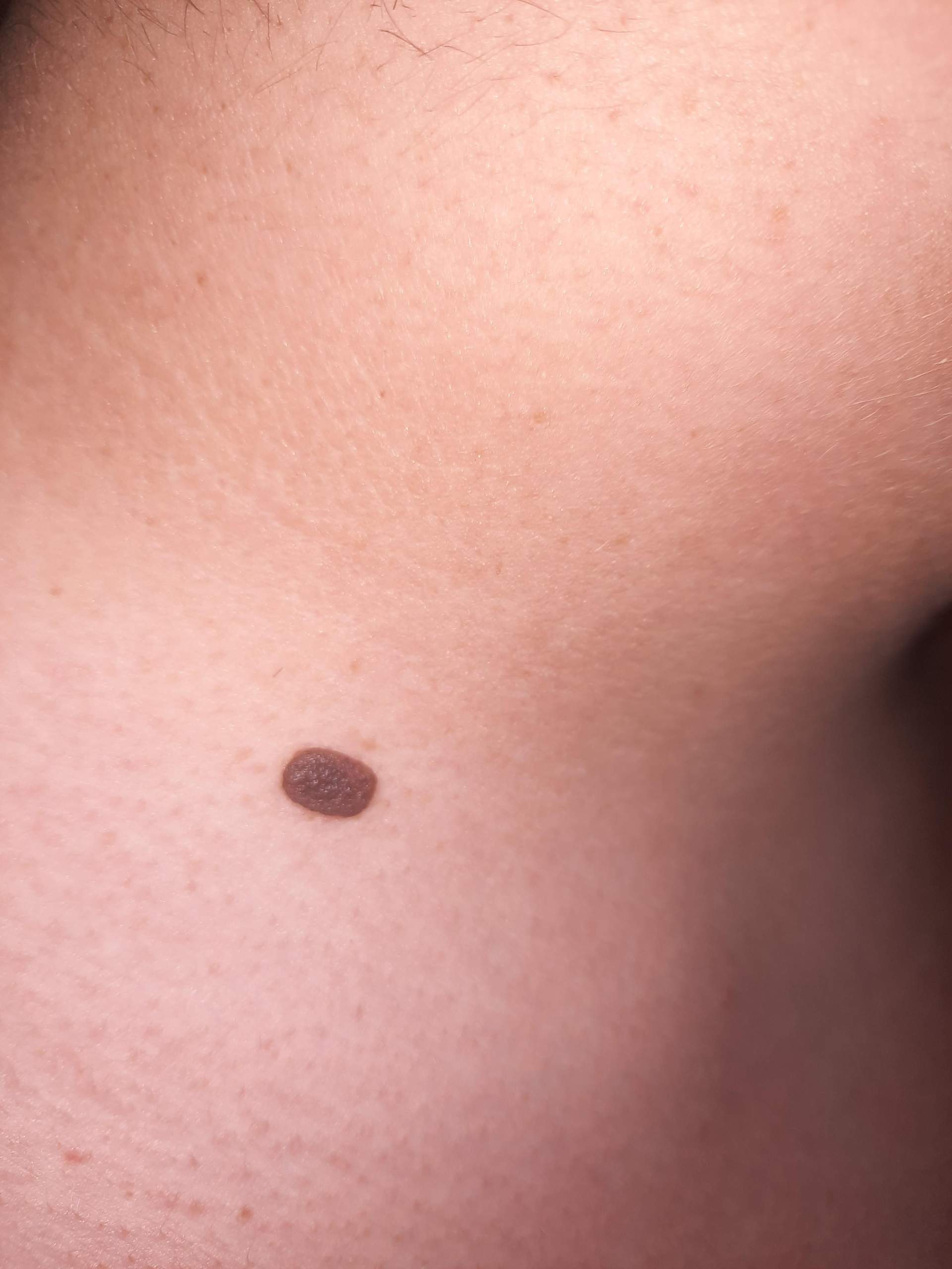 Ist dieser Leberfleck bedrohlich? (Gesundheit und Medizin)