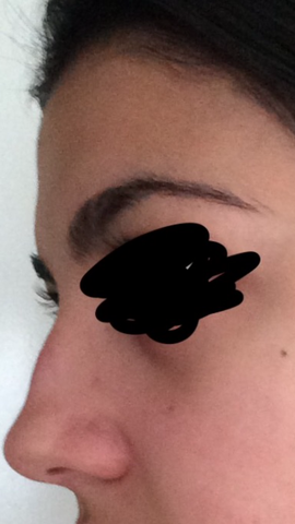 Ist Dieser Nasenbuckel Auffallig Hasslich Mit Foto Nase Nasenkorrektur