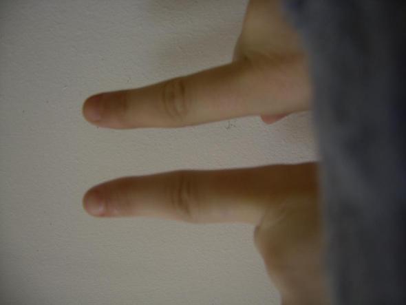 links: der schiefe Zeigefinger, rechts der andere Zeigefinger ("normal") - (Gesundheit, Körper, Schmerzen)