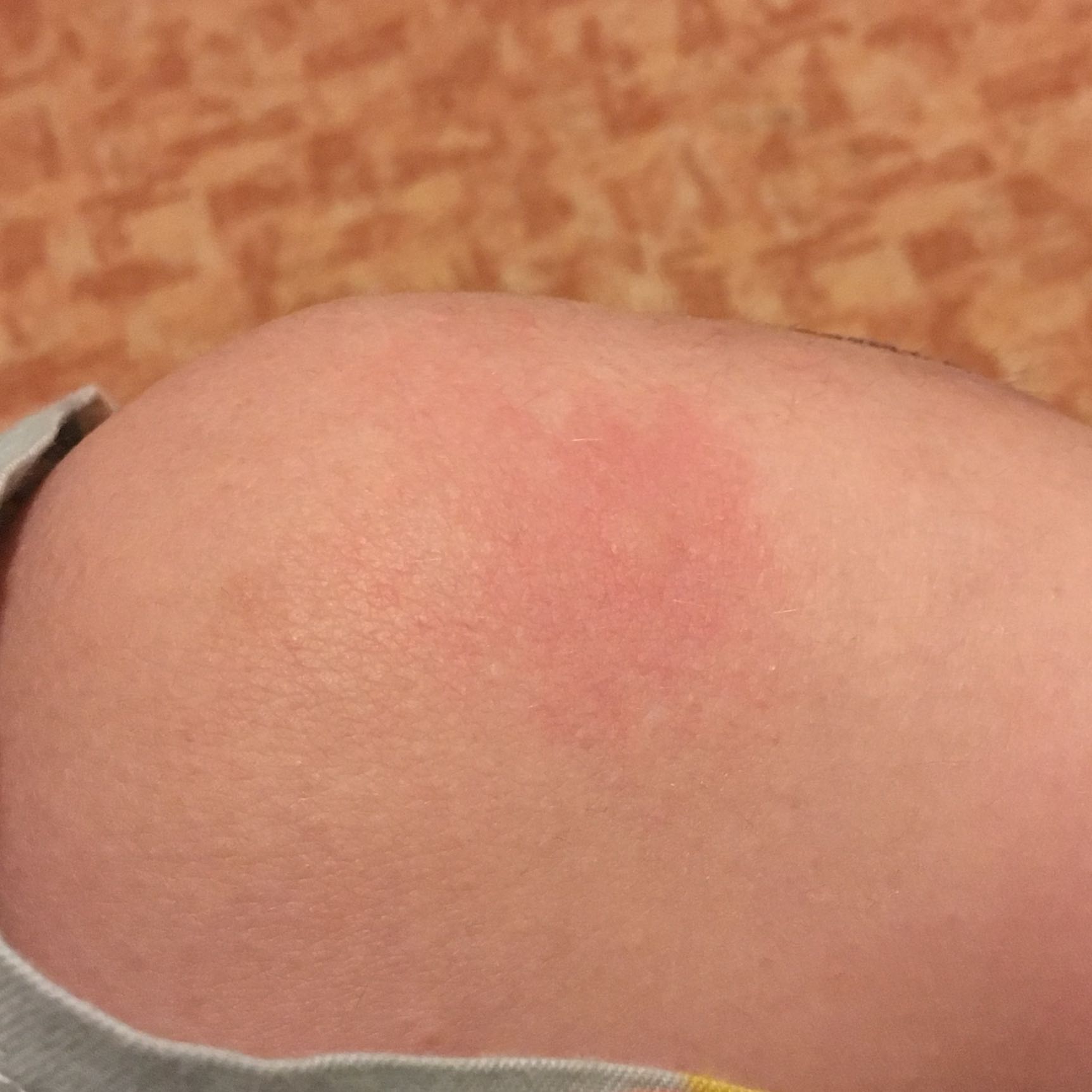 Ist dieser Zeckenbiss normal? (Gesundheit, Medizin, Arzt) Ist dieser Zeckenbiss normal? (Gesundheit, Medizin, Arzt)